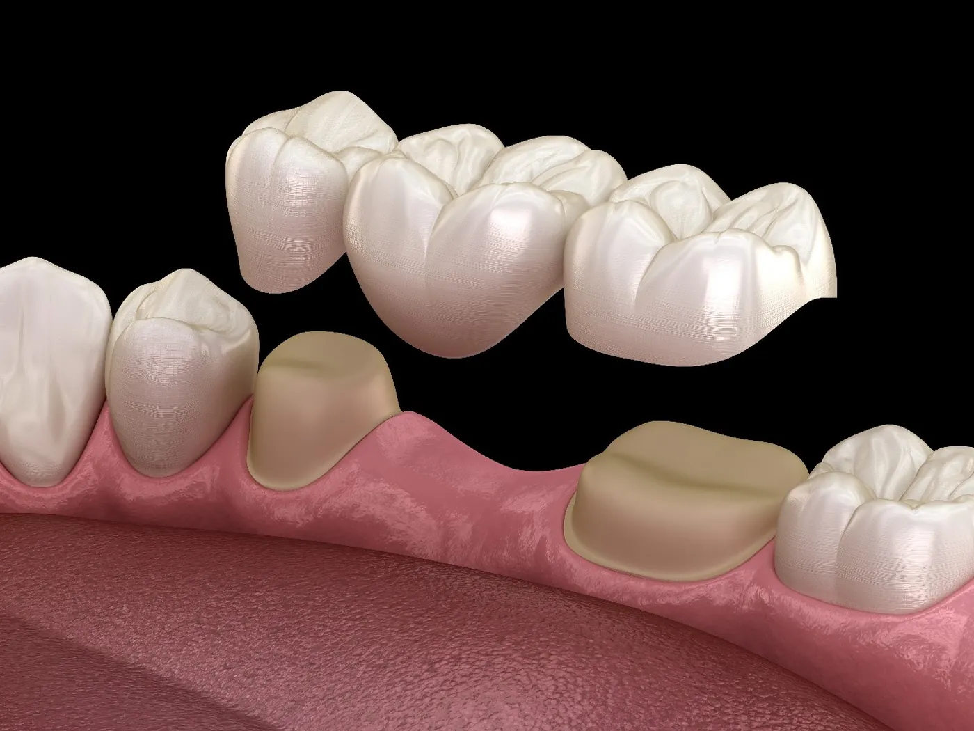 Illustration of a dental bridge replacing a missing tooth