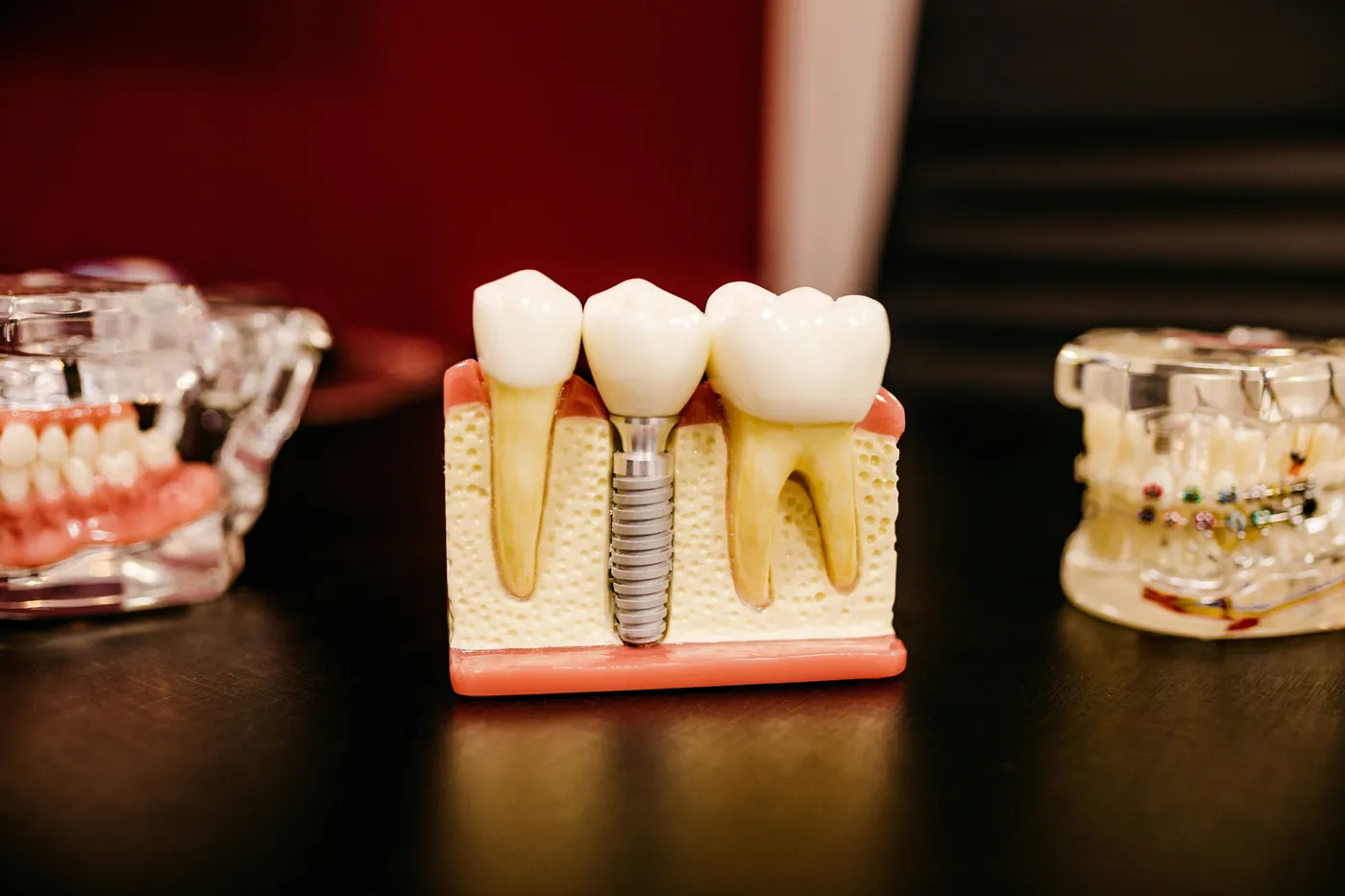 Models of single dental implants with crowns