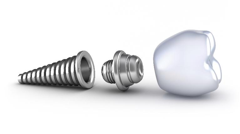 3 Recommendations to Improve Dental Implant Longevity