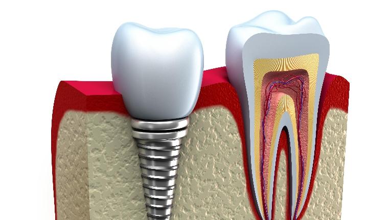 4 Reasons Why Dental Implants Are Today's Gold Standard for Tooth Replacement