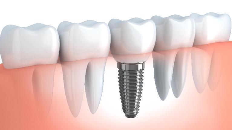 Making Your Dental Implant Last a Lifetime