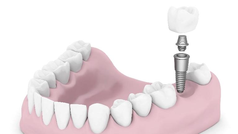 New Research on Implant Integration Means Higher Success Rates