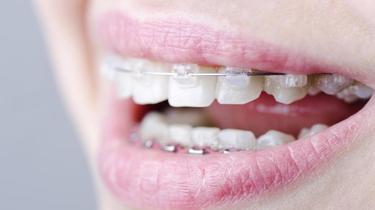What to Expect When It's Time for Orthodontics
