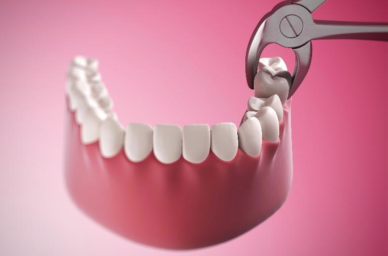 Wisdom Tooth Pain? These 5 Signs May Mean Extraction Is Needed