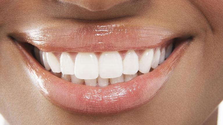 Yes, You Need to Wear a Retainer Following Orthodontic Treatment