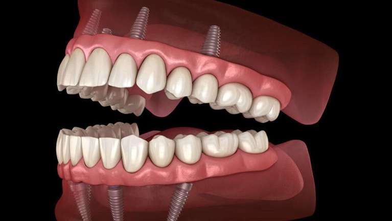 All-on-4® Dental Implants: Which Implant Option Is Right for You?