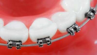 Choosing the Right Dentist for Orthodontics in Elk Grove Village: A Guide for Parents