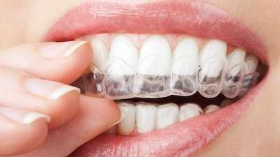 Elk Grove Village Invisalign Providers: Why Clear Aligners Are Trending