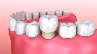 How Dental Crowns Restore Broken and Damaged Teeth