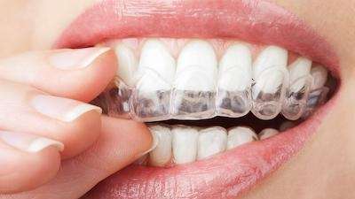 How Does Invisalign Work?