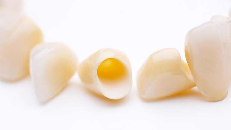 How Long Do Dental Crowns Last?