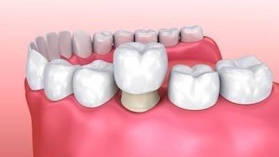 How to Get Dental Crowns in a Day