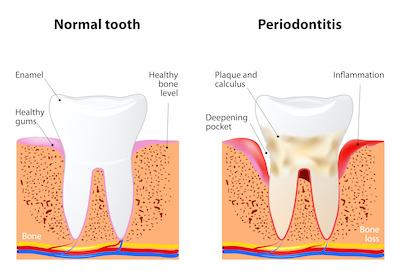Inflamed gums showing gum disease