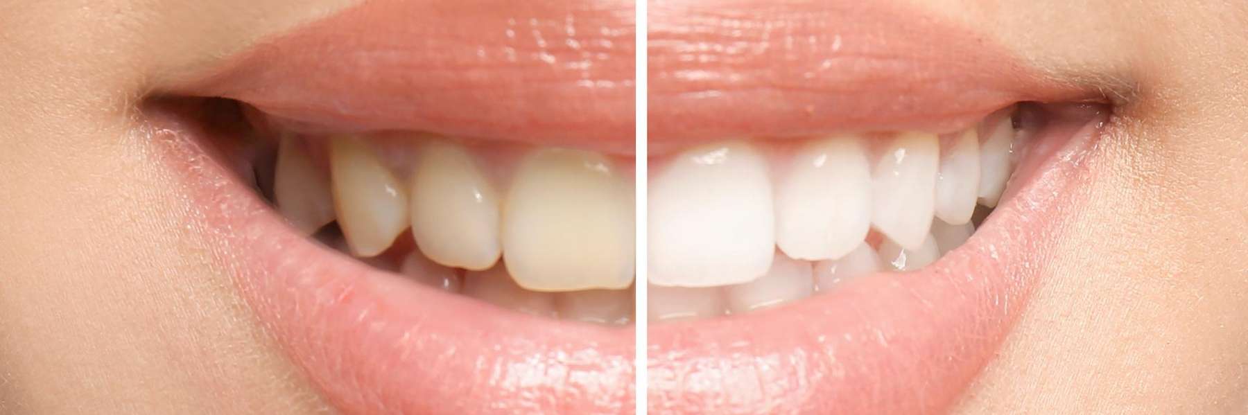 A side by side before and after of Teeth whitening in Elk Grove Village