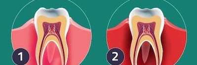 An illustration of teeth showing periodontal disease at Elk Grove Smile Center