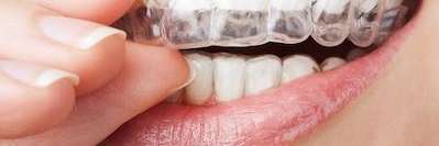 Patient putting Invisalign clear aligners on his teeth at Elk Grove Smile Center