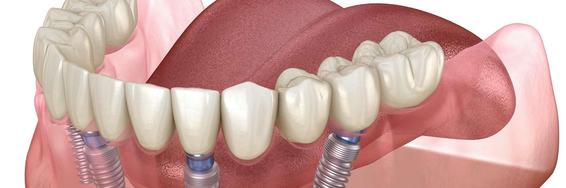 An illustration of a dental implants in Elk Grove village