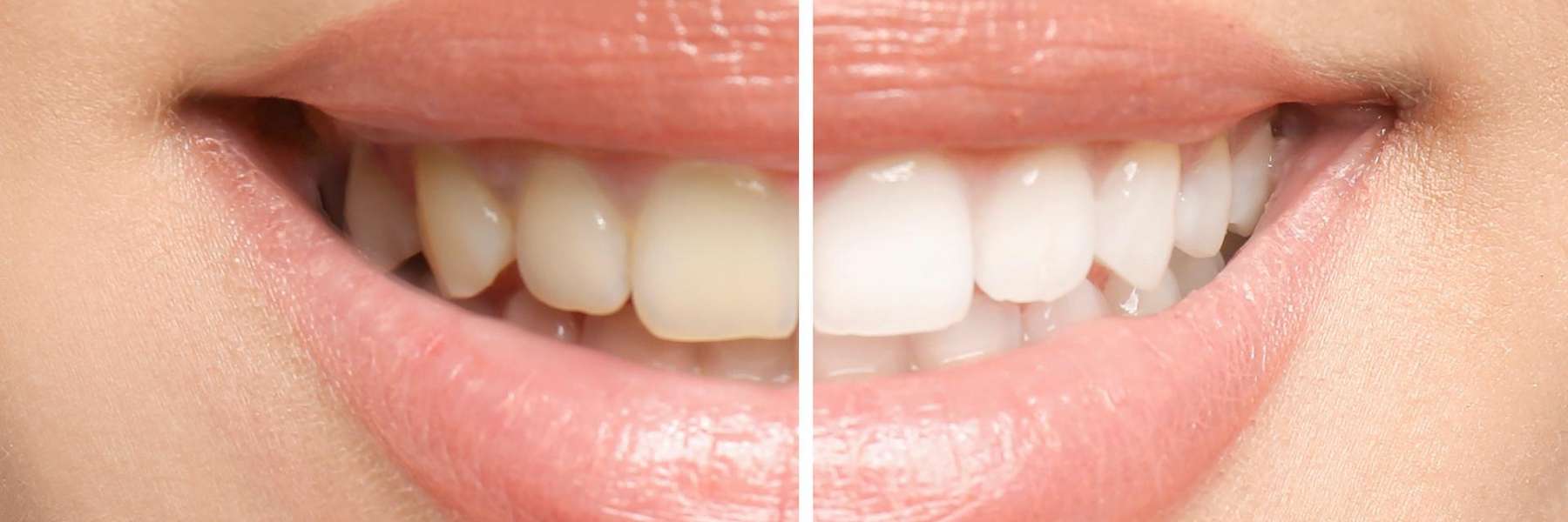 An illustration of teeth before and after whitening in Elk Grove Village, IL