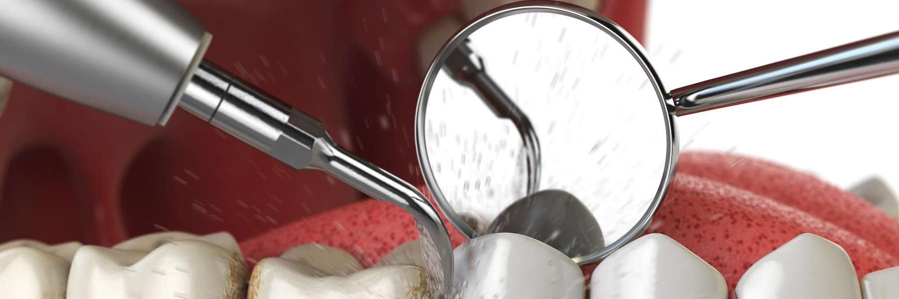 An illustration of dental check up in Elk Grove Village, IL