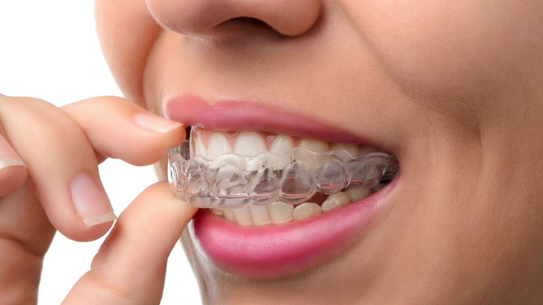  The Invisalign clear aligner in Elk Grove Village, IL