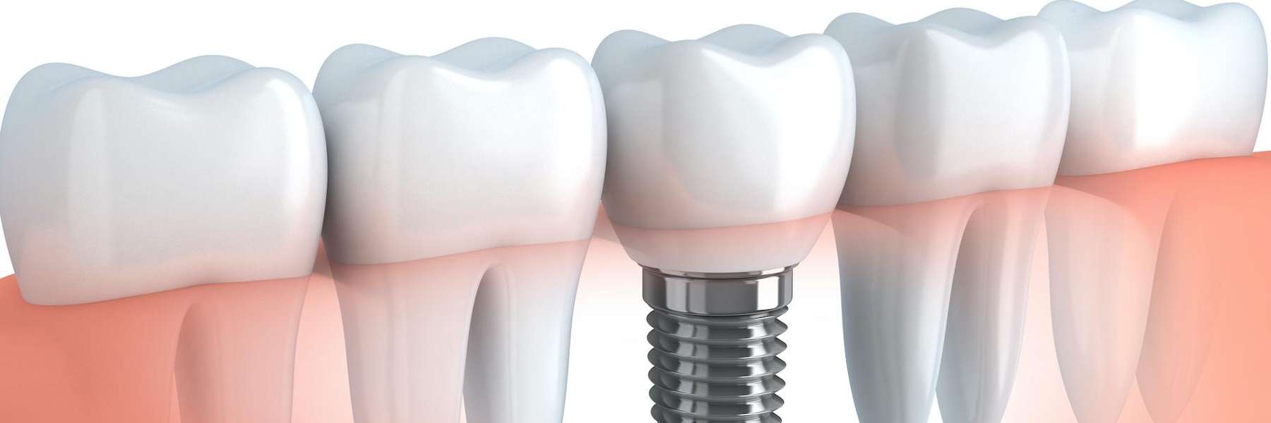An illustration of a dental implant in Elk Grove village Illinois