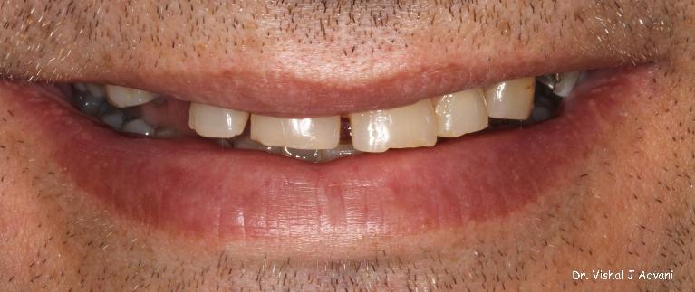 dental extraction elk grove village il